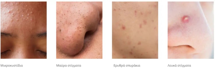 Είδη Απο Σπυράκια: Μικροκυστίδια, Μαύρα Στίγματα, Λευκά Στίγματα, Κόκκινα Σπυράκια